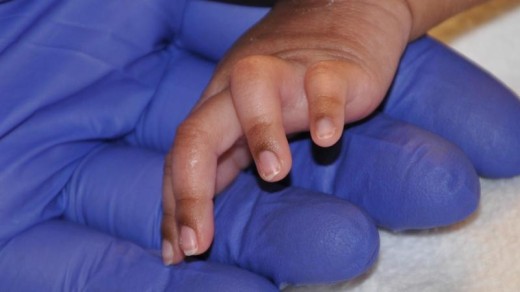 Beide ringvingers van de baby hebben een afwijking, ze zijn permanent gebogen | Politie Amsterdam .
