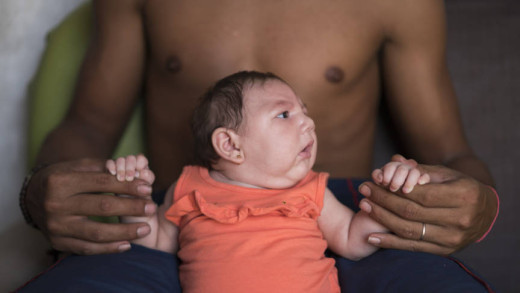 Een van de baby's die vorig jaar in Brazilië is geboren met onvolgroeide hersenen door het zika-virus | Fotio Hollandse Hoogte - AP 
